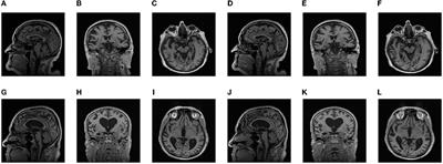 Development and validation of a deep-broad ensemble model for early detection of Alzheimer's disease